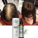 Rosemary Oil Hair Growth and Scalp Treatment